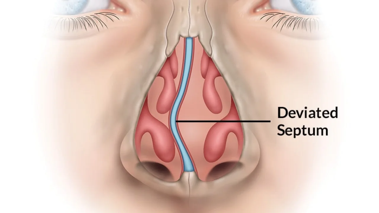Is Your Nose the Real Reason Behind Your Snoring?