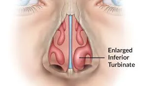 Is Your Nose the Real Reason Behind Your Snoring?